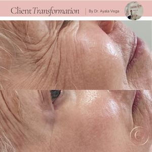 Neuromodulators-before