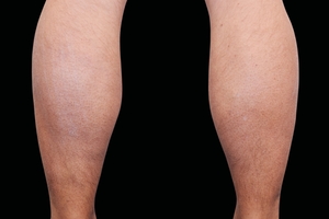 4 Treatments-before