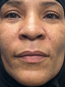Lip filler Versa-after