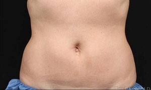 Liposuction - Abdomen-after