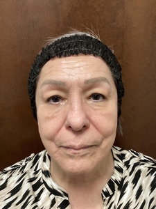 1 month after 3rd Secret RF treatment-before