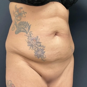 Tummy Tuck #10-before
