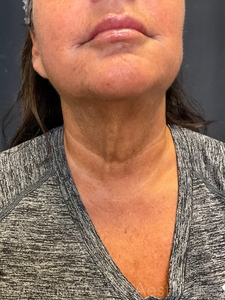 fusion tip rt topical lt infused exosomes-after