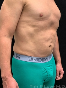 Abdominoplasty - Mini-after