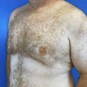 Male Breast Reduction #3 (left oblique)-after
