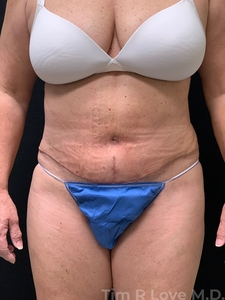 Abdominoplasty - Traditional-after