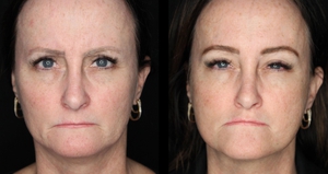 chotox - 20u gl, 10 u fh, 24u CF, 6u lips, 6u mentalis-before