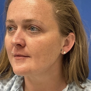 Lipo w Skin Tightening Face #7-after