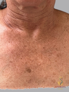 One week post Nouvaderm MOD-after