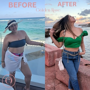 Medical Assisted Weightloss-before