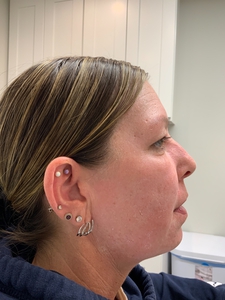 treatment for acne scarring-after