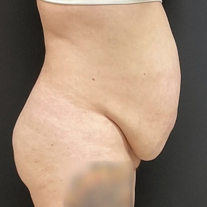 Tummy Tuck #11-before