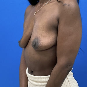 Breast Augmentation #6 350 cc-before