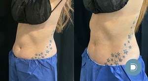 Coolsculpting-before