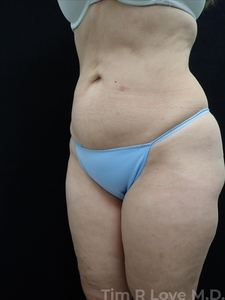 BodyTite - Abdomen-after