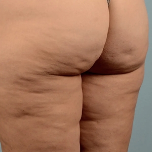 Cellulite Reduction #3-before