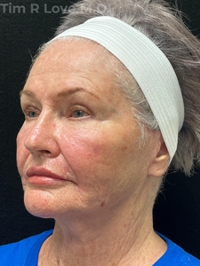 1 year post op short scar face lift, lip lift,  MyEllevate, FaceTite, Morpheus8, Sculptra, and lip filler-after