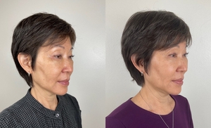 SCULPTRA  (2 VIALS)-before