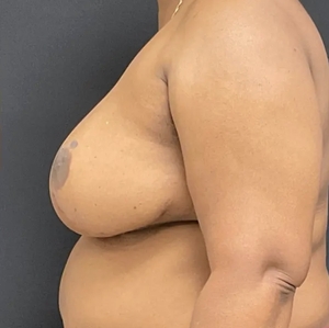 Breast Reduction #5-after
