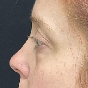 Brow & Eye Lift #4-before