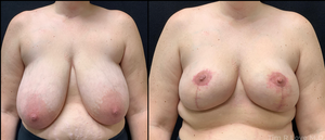 2 months PO.-before
