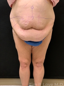 Abdominoplasty - Traditional-before