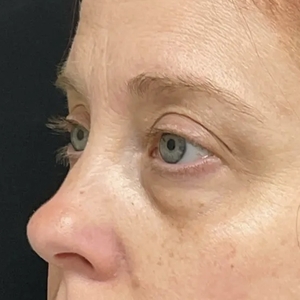 Brow & Eye Lift #4-before