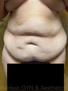 16 WEEKS POST TREATMENT-before