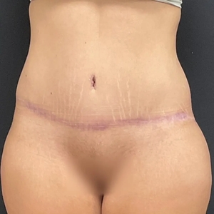 Tummy Tuck #7-after
