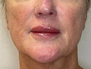 DEKA Pulse Ablation-after