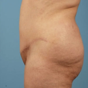 Mommy Makeover #8-after