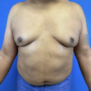 Lipo w Renuvion #9-after