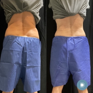 Coolsculpting - 2 cycles on each side of back/bra, 2 cycles on each flank-before