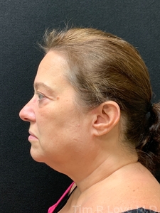 With NanoFat and upper Bleph-before