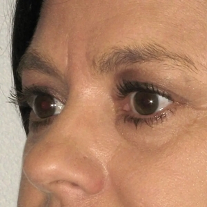 Brow & Eye Lift #5-before