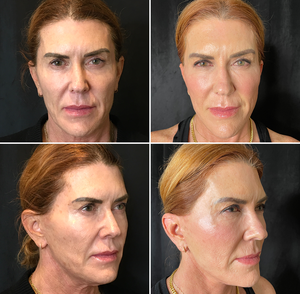 Rhytidectomy (Facelift), Fat Transfer to cheeks, and TCA Peel-before