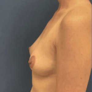 Breast Augmentation #6 355 cc-before