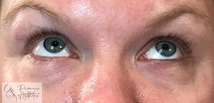 Restylane Filler Microcannula Technique-before