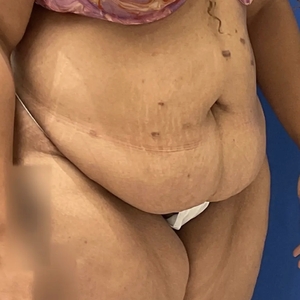 Tummy Tuck #12-before