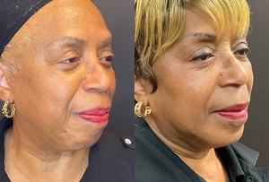 Chin Filler #voluma-before