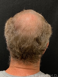 3000 grafts-before
