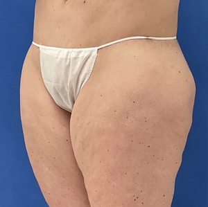 Lipo w Renuvion #1-before