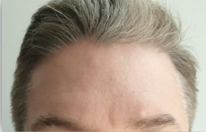 Dry, dehydrated skin-after