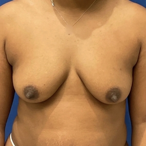 Breast Augmentation #3 400 cc-before