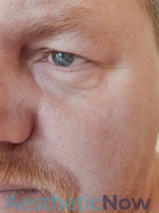 Laser Resurfacing-before