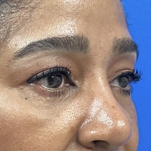 Brow & Eye Lift #3-after
