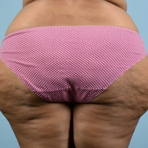 Cellulite Reduction #2-before