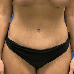 Tummy Tuck #3-after