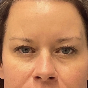 Brow & Eye Lift #2-before