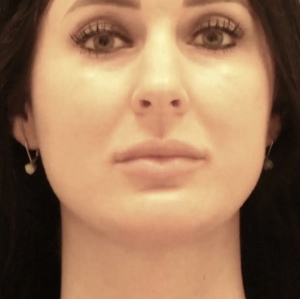 Lipo w Skin Tightening Face #1-after